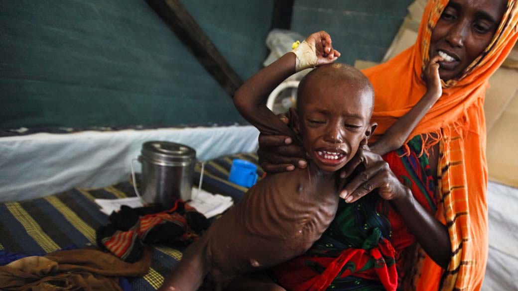 Em foto do dia 17, divulgada hoje, criança somali desnutrida em clínica da organização Médicos Sem Fronteiras na cidade de Dadaab, no Quênia. O campo para refugiados da região é o maior do mundo, com a capacidade para 90 mil pessoas