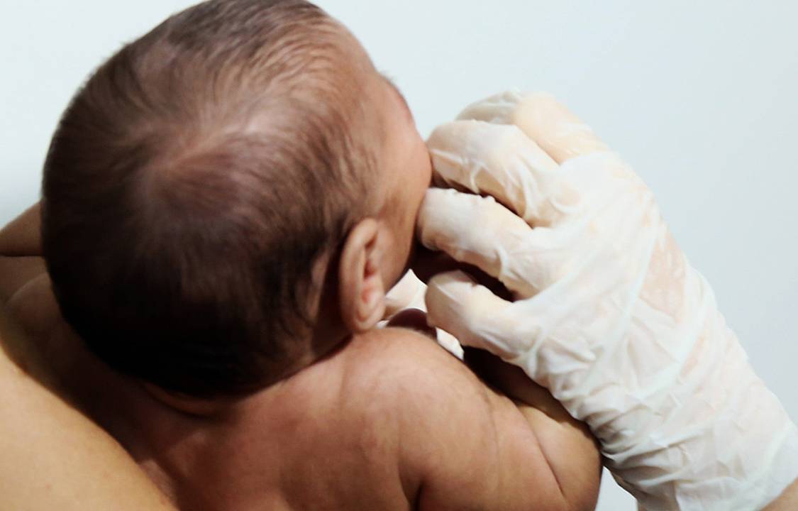 Além do tamanho reduzido do crânio - principal característica da microcefalia -. a menina nasceu com problemas intestinais e visuais.