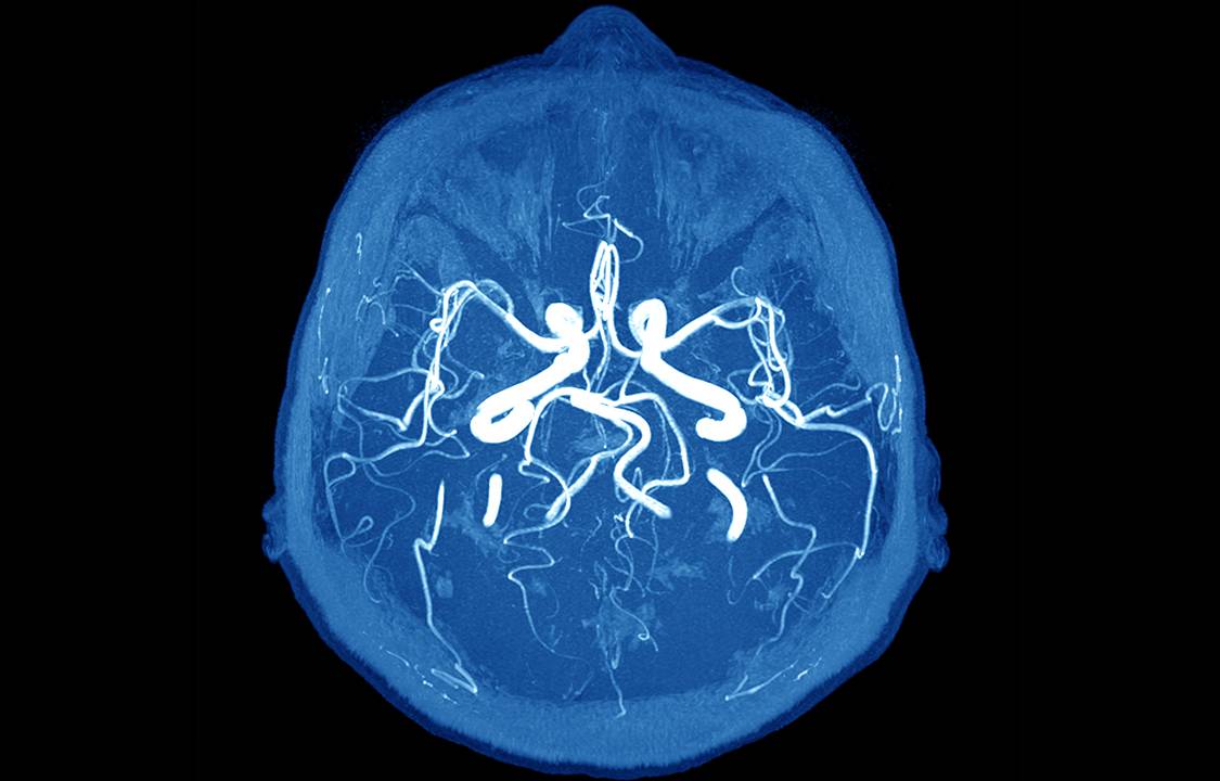 Imaging of the brain on mri scan