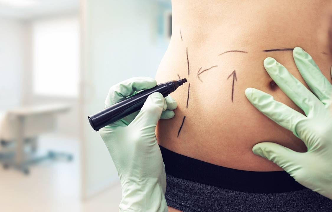 Lipoaspiração