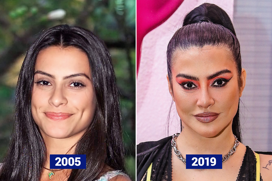 Harmonização facial: nova moda entre famosas que buscam a selfie perfeita