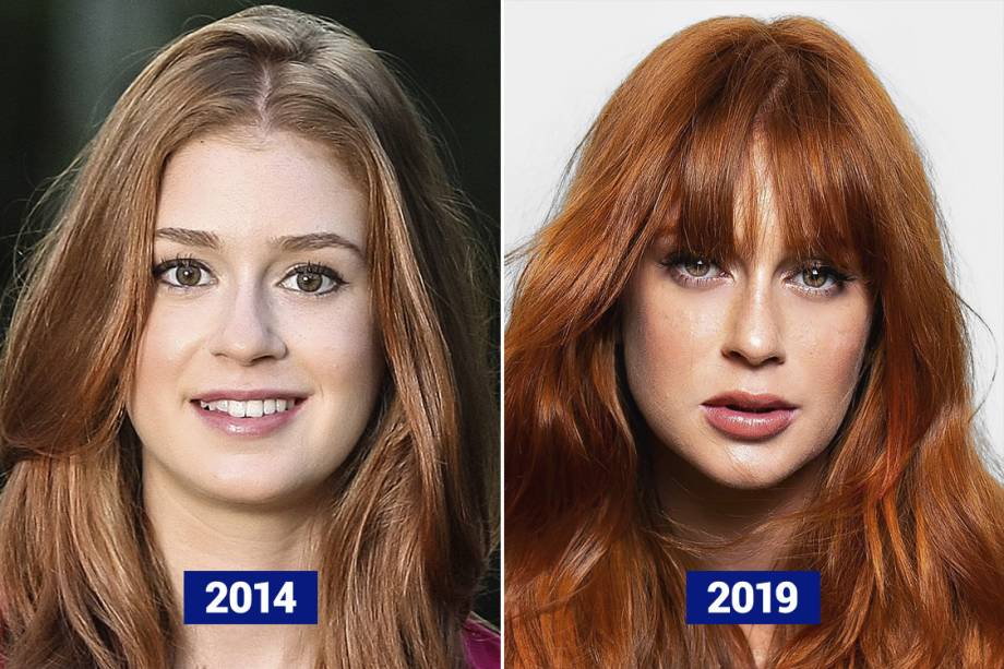 MARINA RUY BARBOSA, 24 ANOS - Uma das atrizes mais lindas do Brasil, Marina Ruy Barbosa de-tes-ta falar de procedimentos estéticos. Seus lábios, no entanto, não enganam: foram preenchidos de forma a deixar uniforme o volume das partes inferior e superior. O queixo ficou mais pronunciado. Resultado: efetivo, mas discreto