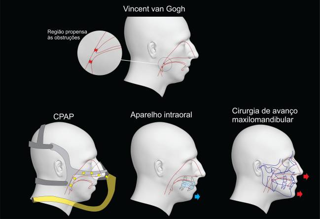 unnamed a face em perfil de van Gogh salientando a região onde ocorrem os colapsos que obliteram a via aérea de forma total (apneia) ou parcial (hipopneia) -