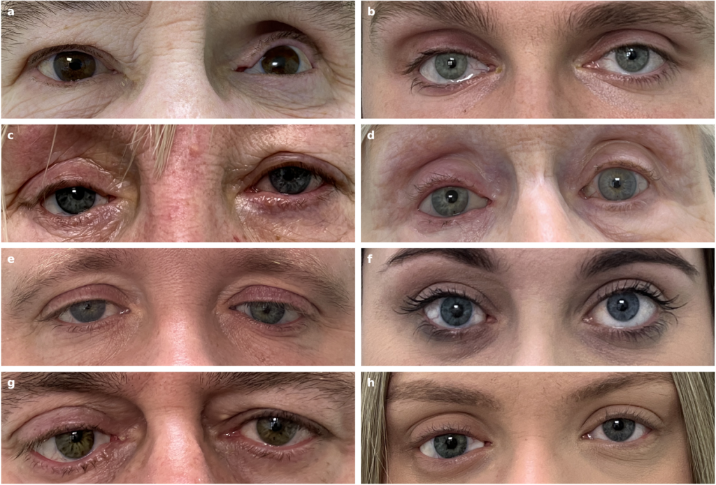 3 OLHOS FIDEDIGNOS - Próteses: versão artificial é muito semelhante à real