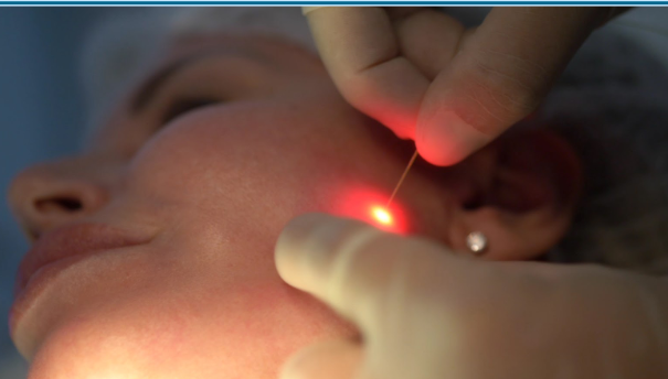 Laser italiano: inovação estética para flacidez