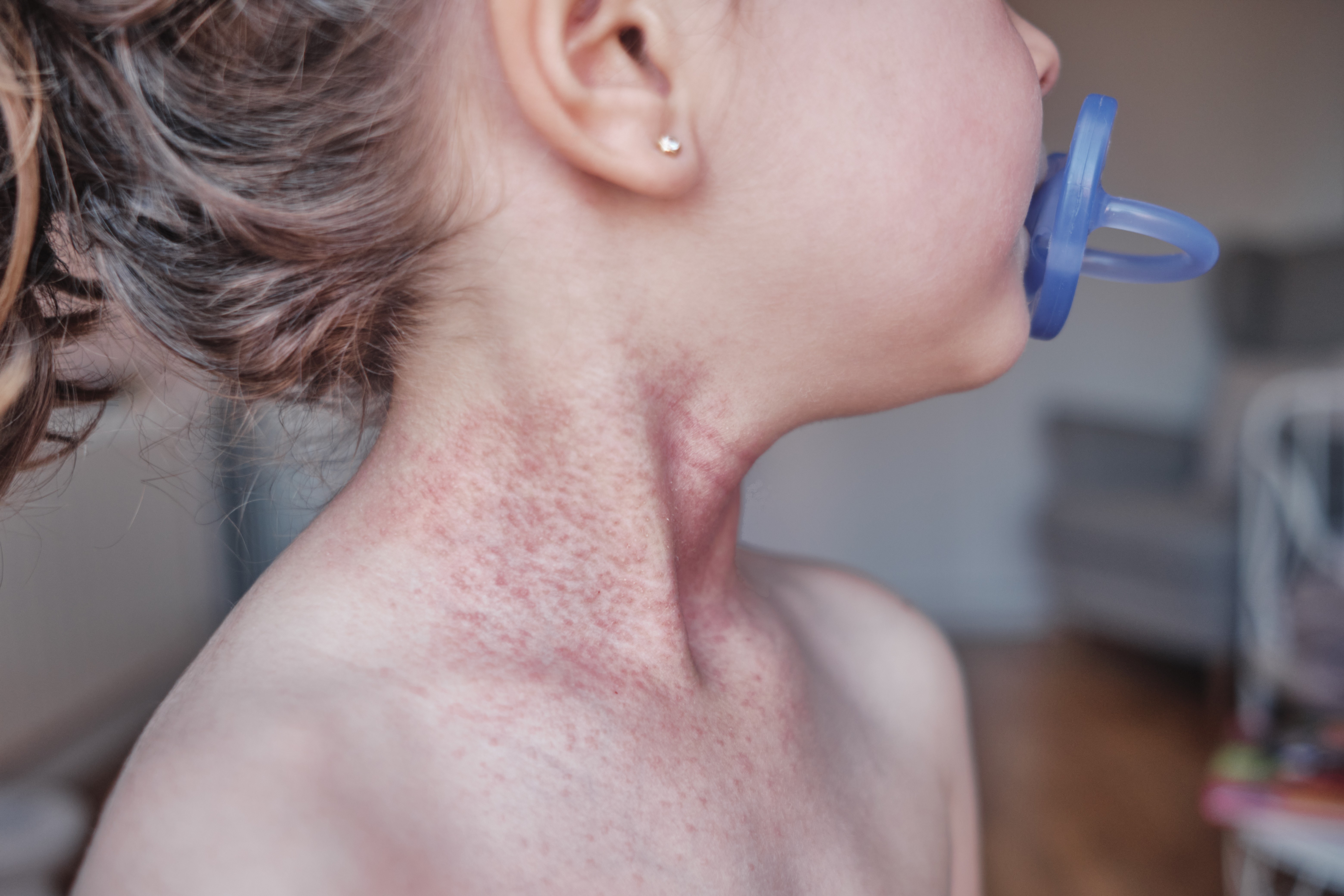 Muito além da pele: a realidade de quem vive com dermatite atópica no SUS